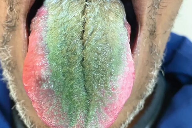 why is my tongue green