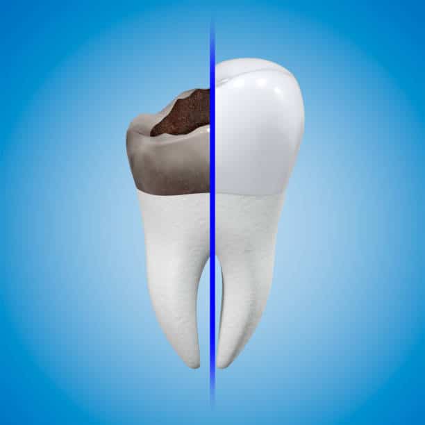 how long does a root canal take